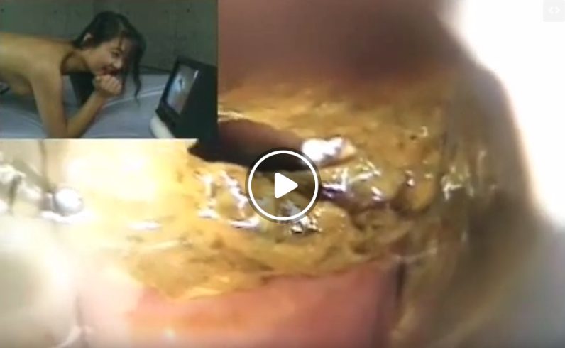 腸内にうんこがガッツリ詰まっている女性